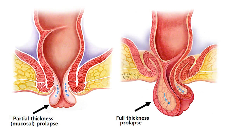 Hình ảnh minh họa tình trạng sa tử cung